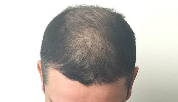 Greffe de cheveux manque de densite