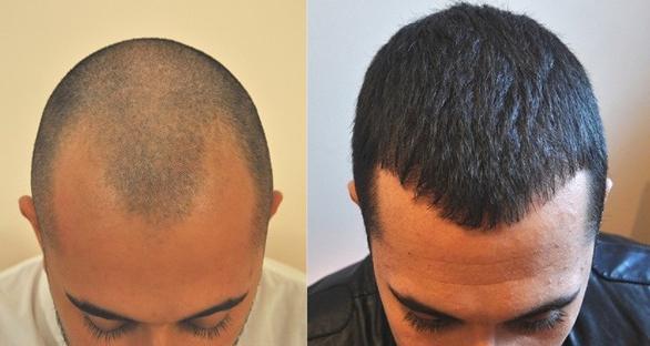 Greffe de cheveux France Paris