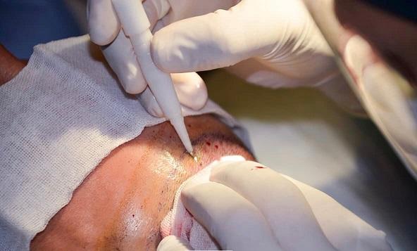 Greffe dhi vs saphir fue