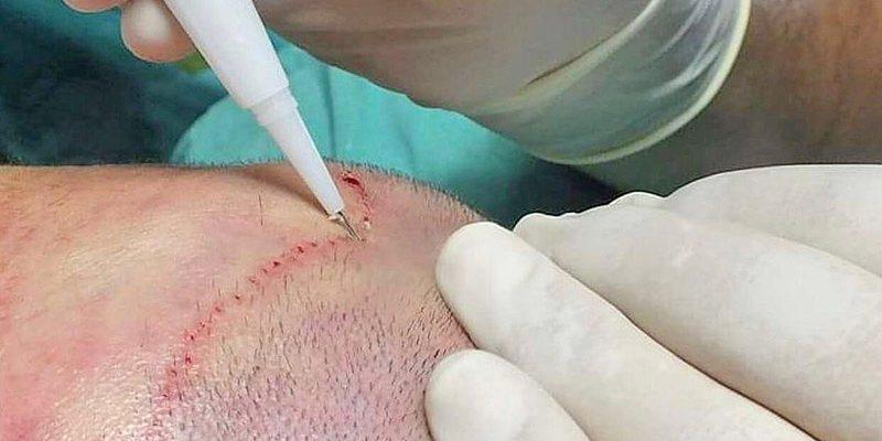 Implant capillaire dhi france